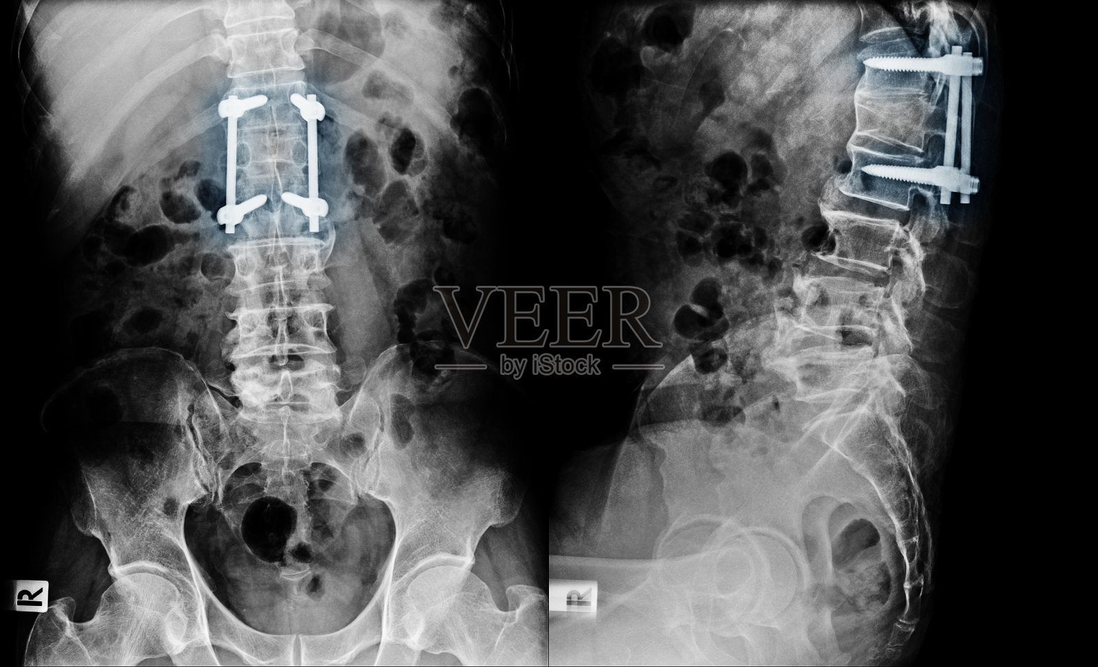 退行性腰椎间盘病减压及铁棒螺钉固定术后的腰椎x线影像照片摄影图片