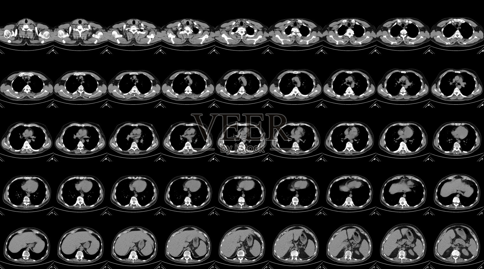 胸腔Cat扫描照片摄影图片
