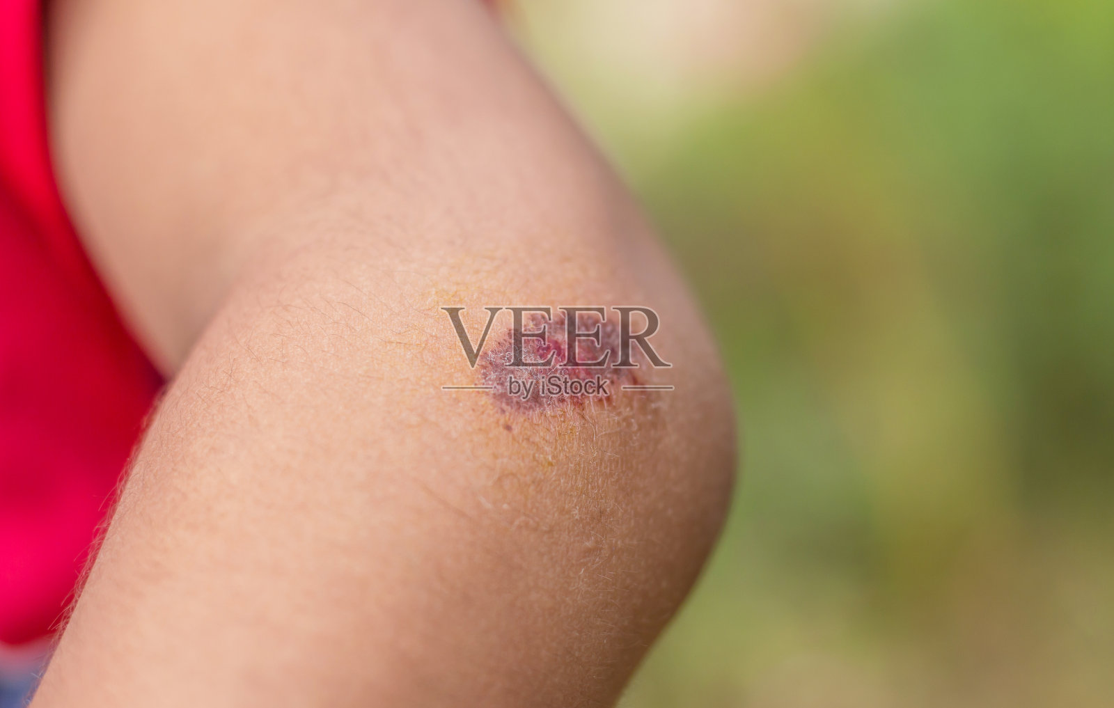 儿童膝盖受伤事故后跑事故。照片摄影图片