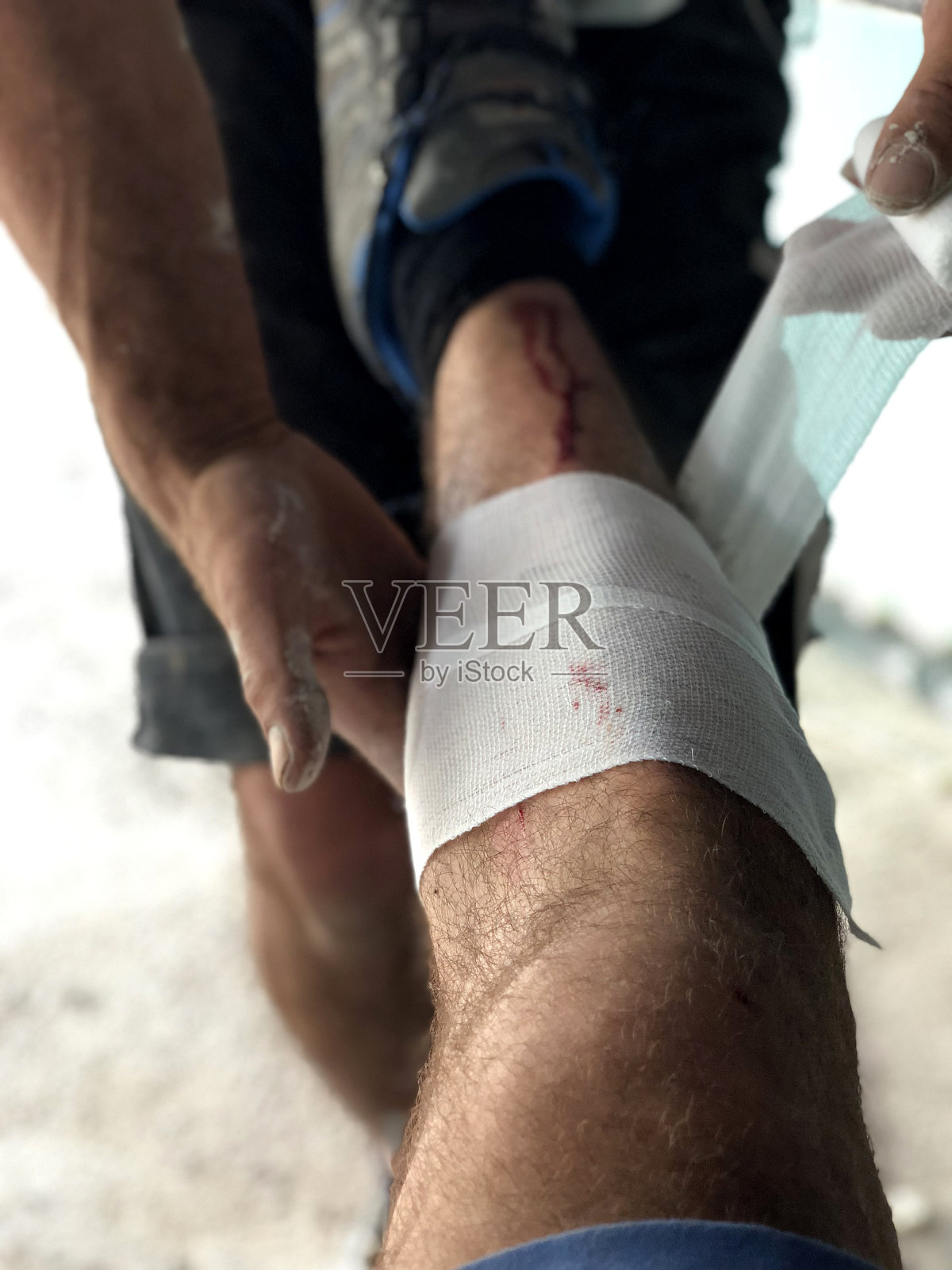 腿部损伤的治疗照片摄影图片