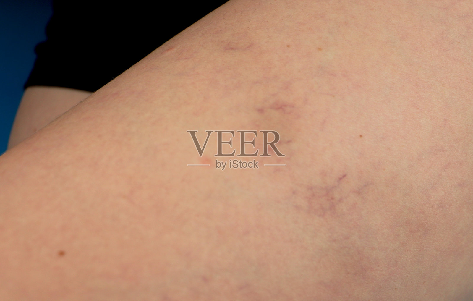 腿部静脉曲张和毛细血管。医疗检查和治疗照片摄影图片