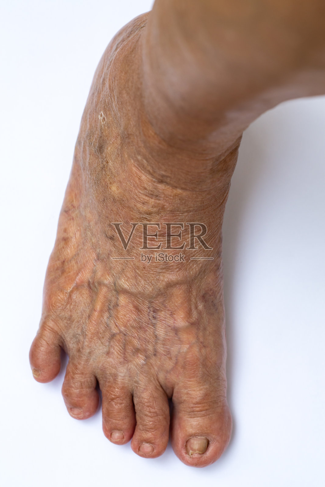 右脚静脉曲张，趾甲受损，老年女性脚趾弯曲，白色背景，近景微距拍摄，选择性聚焦，身体部位，亚洲皮肤概念照片摄影图片