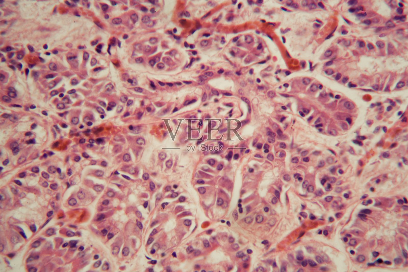 肺栓塞患者肺组织的显微镜观察。照片摄影图片