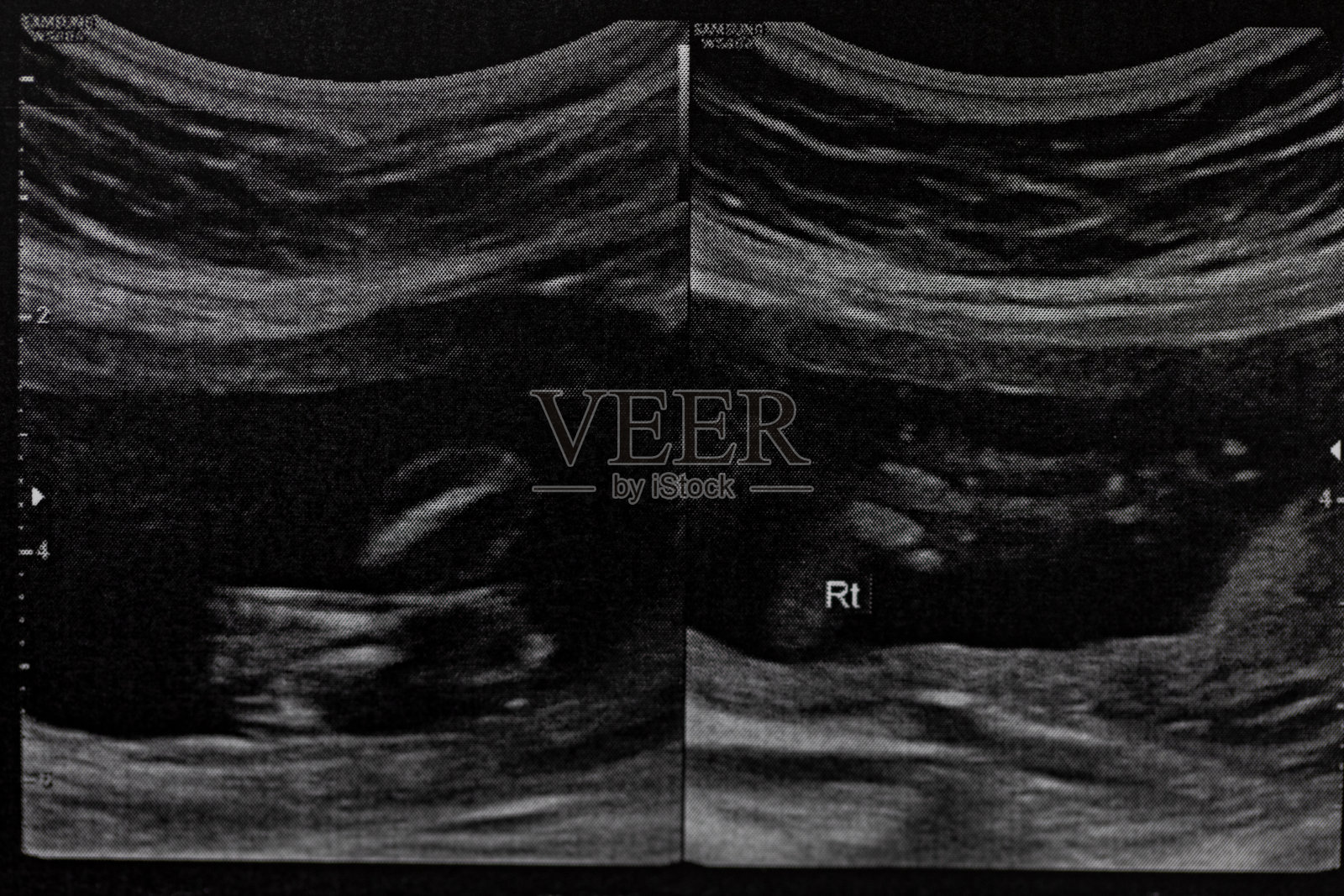 母亲在医院检查婴儿的超声波。照片摄影图片