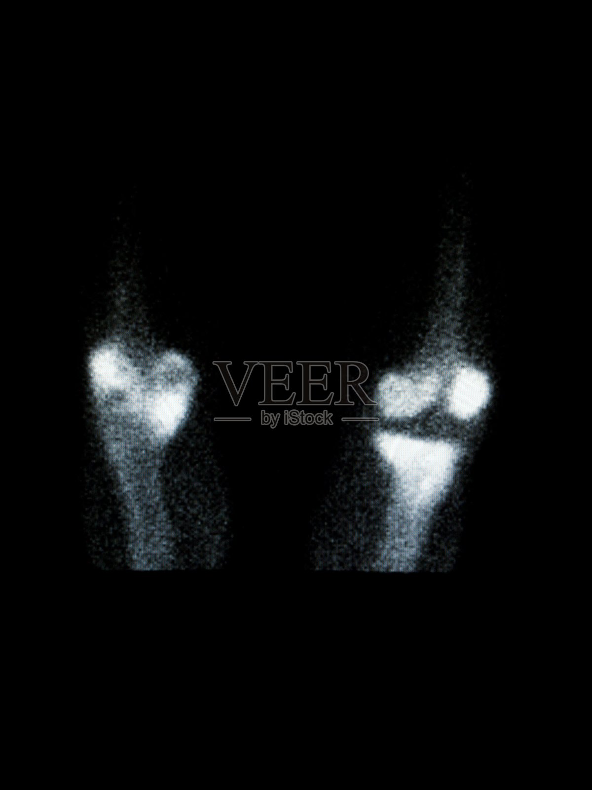 膝盖的一个点图像。股骨和胫骨在骨显像上可见。照片摄影图片