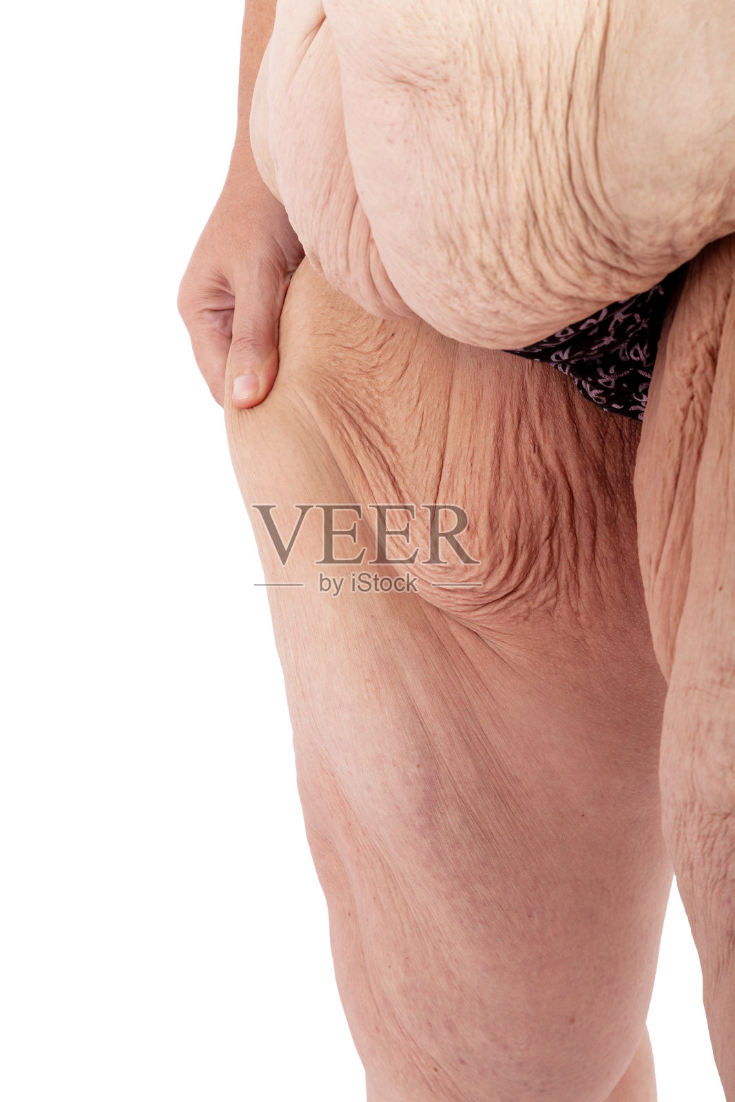 面向左侧，保留成熟女性在行腹部切除术、胸膜切除术或围裙切除及大腿内侧复位前多余的大腿皮肤。海报和模因的灵感，之前的臂成形术，膜切除术，腹部成形术在澳大利亚。照片摄影图片