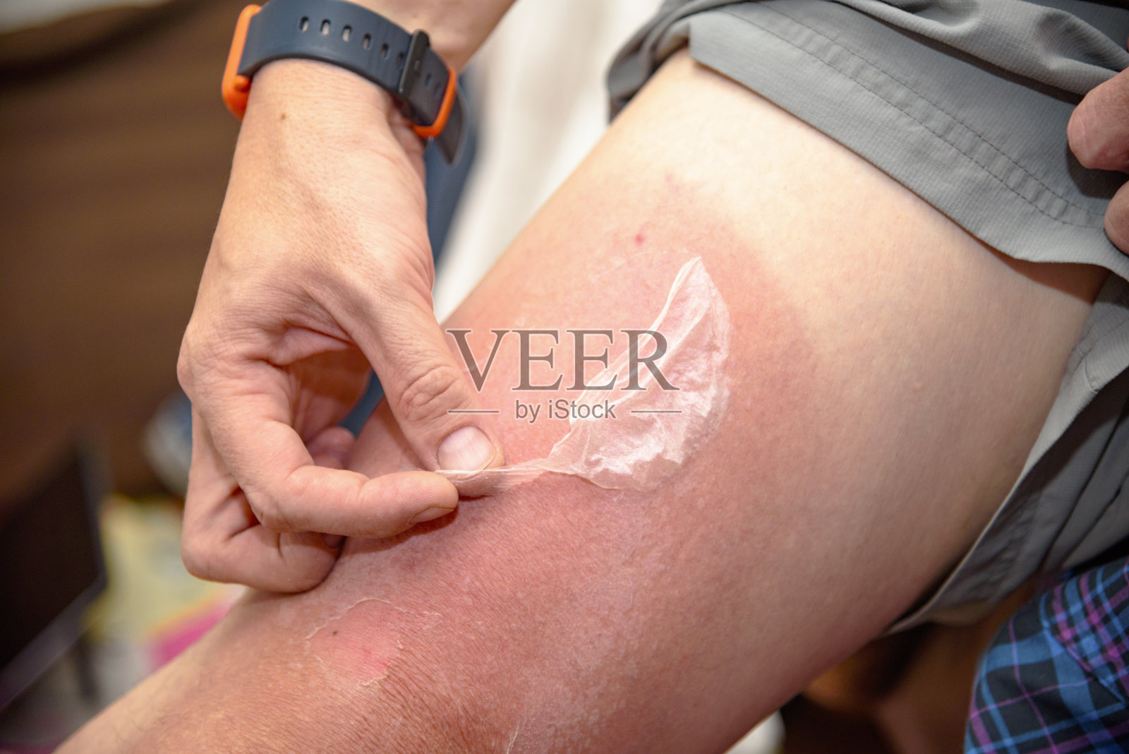 灼伤了人的皮肤照片摄影图片