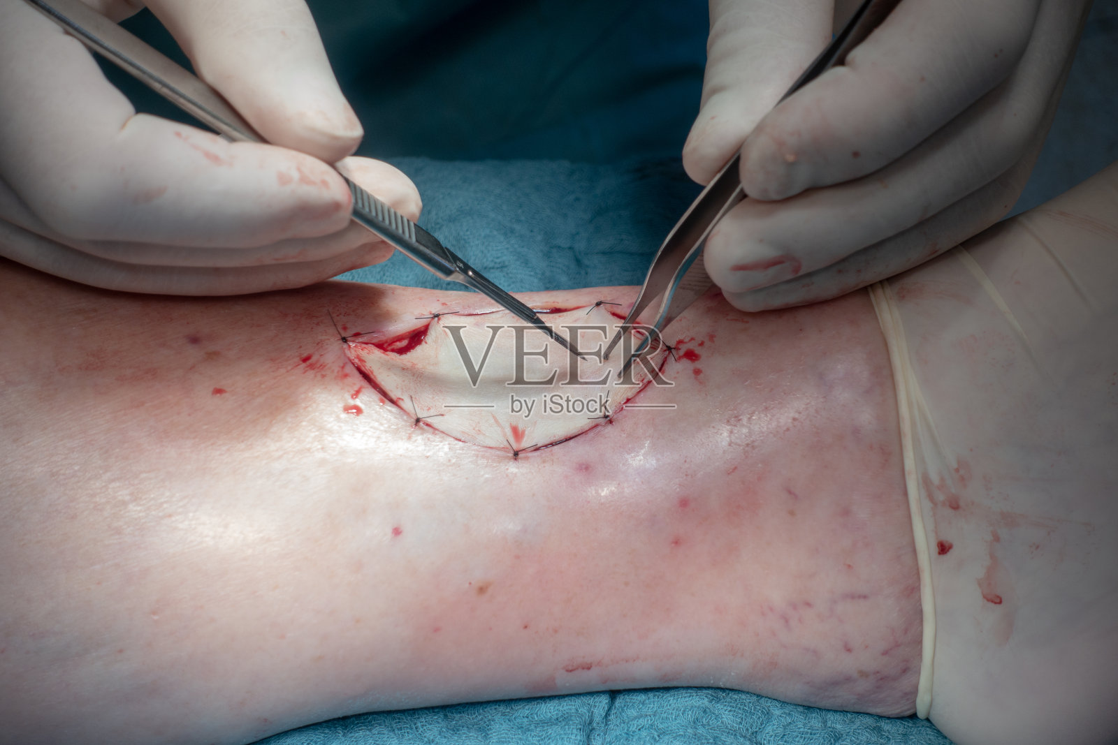 医生做外科手术照片摄影图片