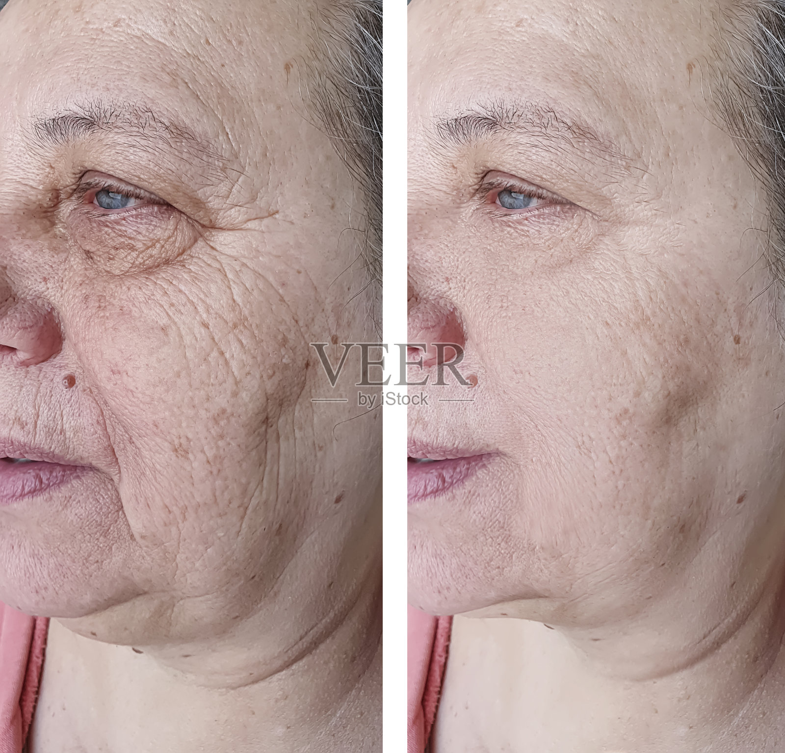 一个老女人在治疗前后的脸照片摄影图片