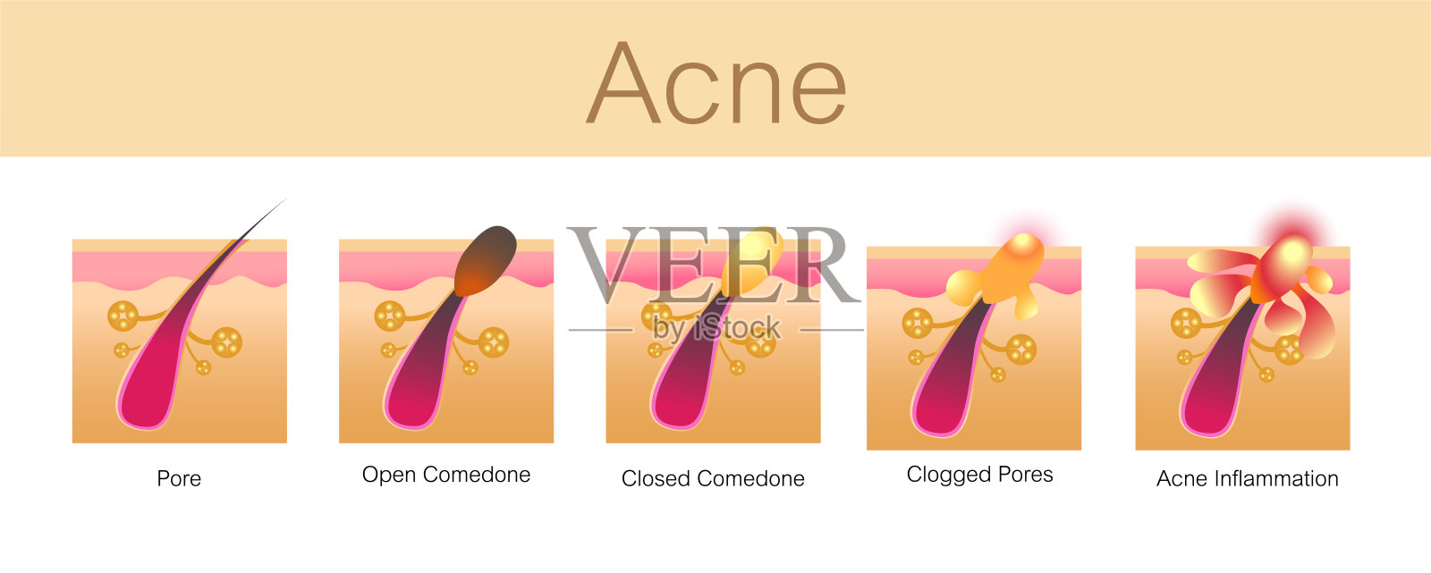 粉刺，发育阶段，健康皮肤，矢量设计插画图片素材