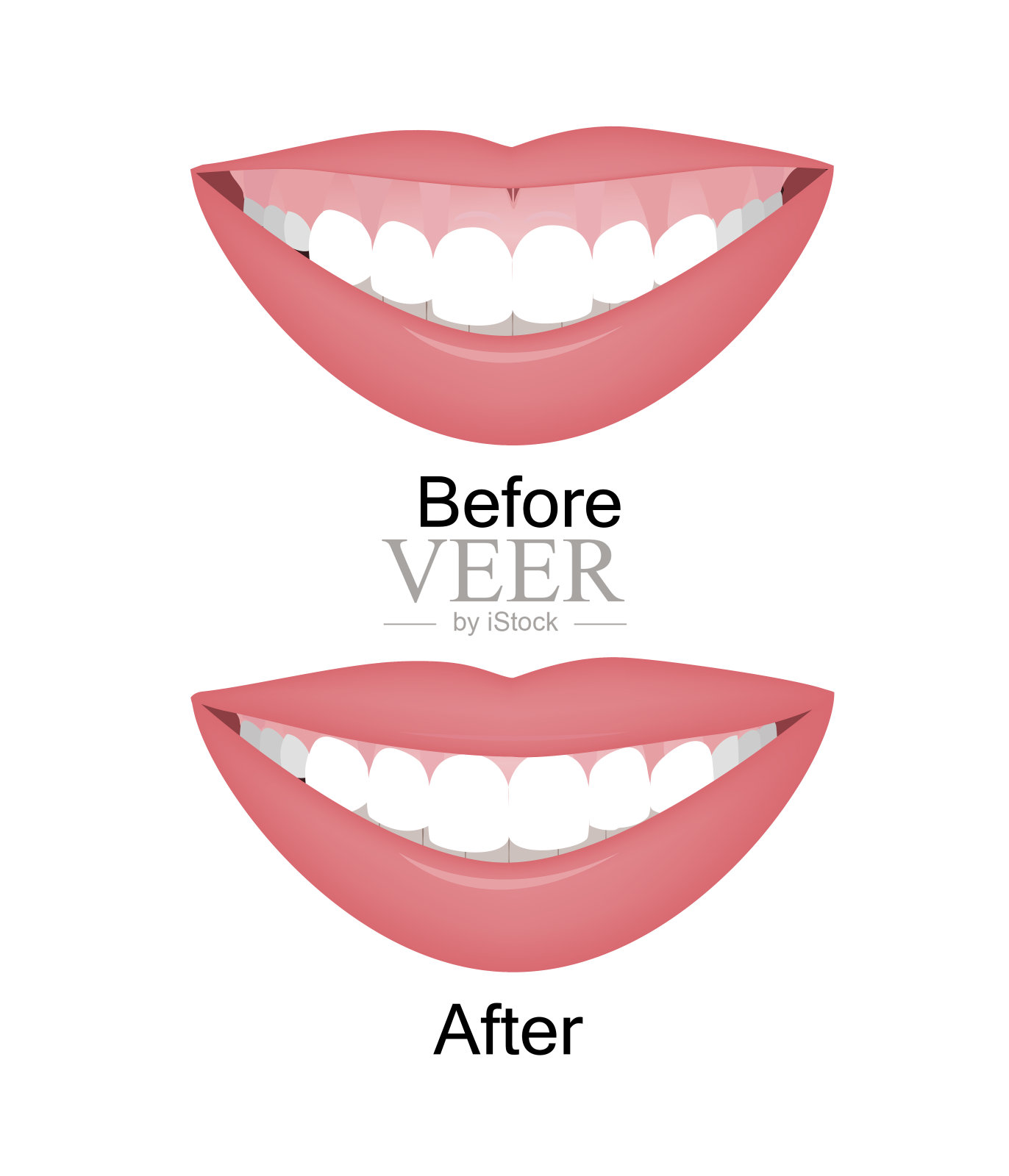 嘴角带着高笑线或软糖微笑前后矫正，矫正或注射肉毒杆菌素矫正。矢量图插画图片素材