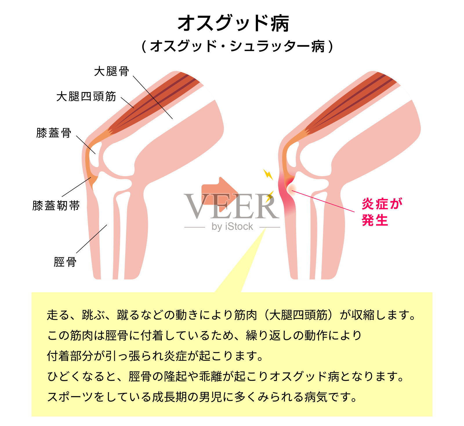 osgood - schater病(膝关节病)图解(附说明文字)/日语插画图片素材
