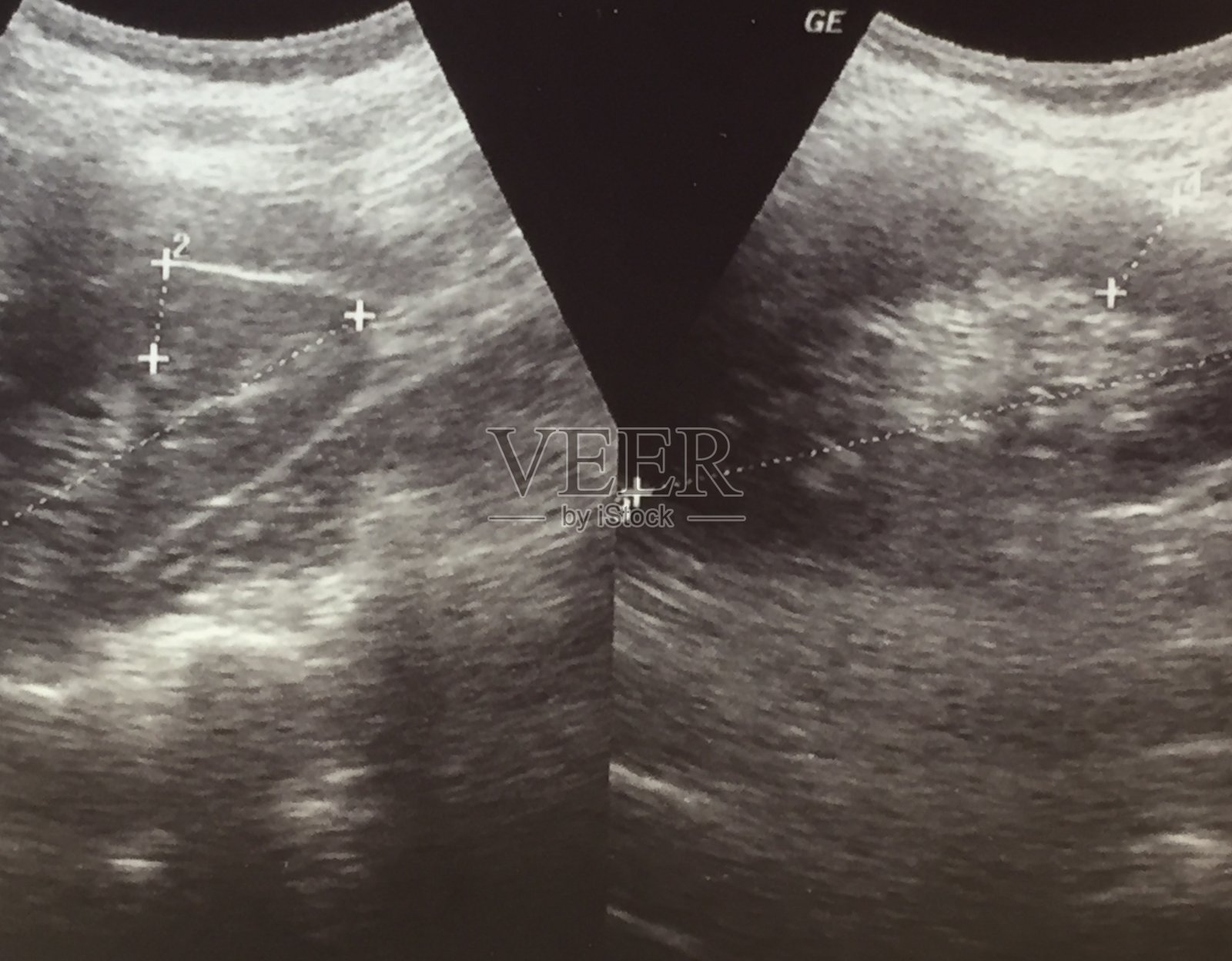 人体肾脏超声检查照片摄影图片