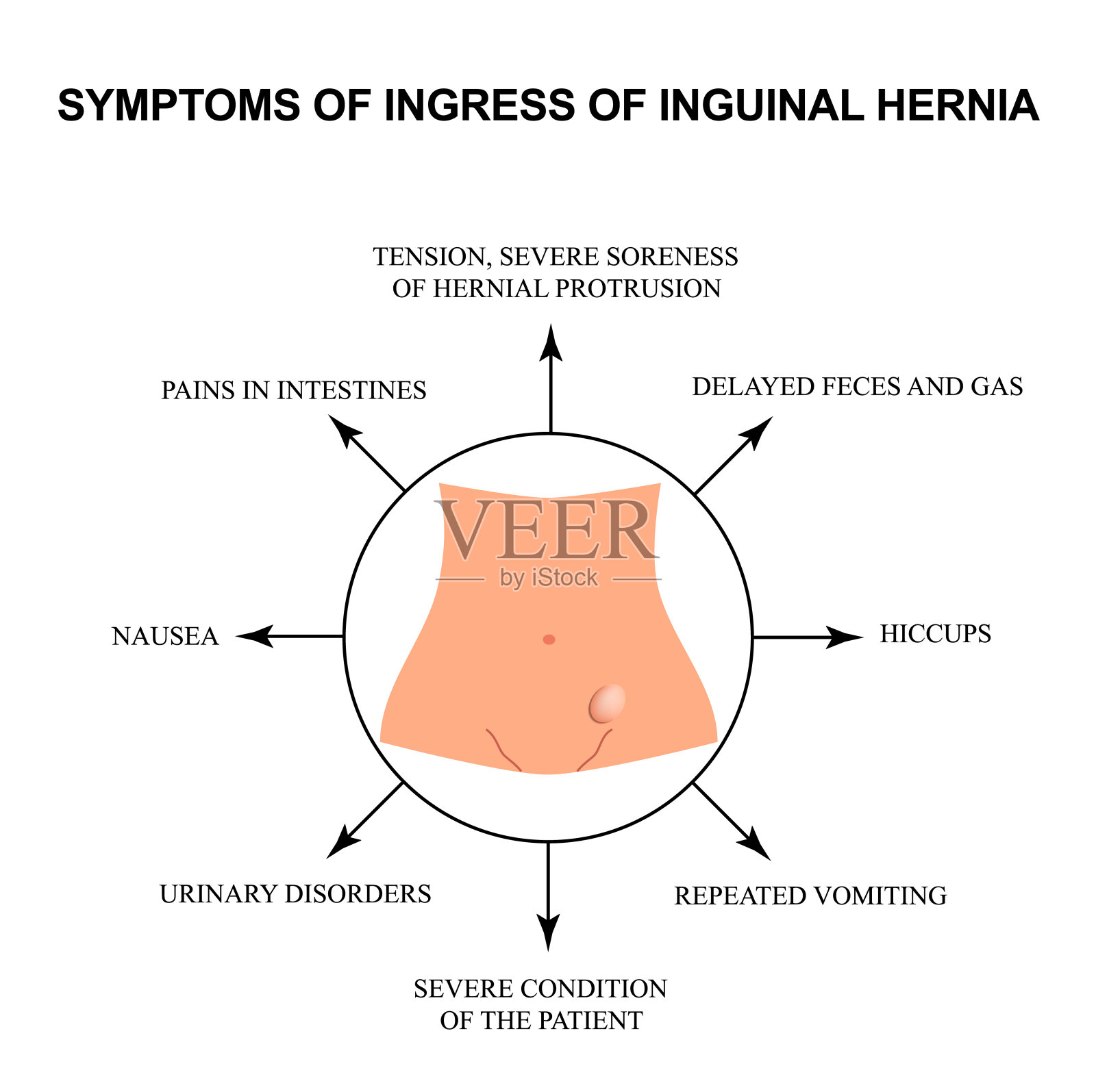 腹股沟疝受损症状。信息图。矢量插图在孤立的背景。插画图片素材