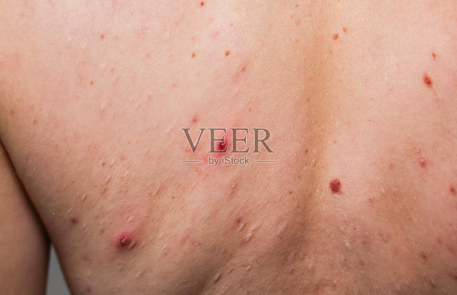 女孩背上有许多胎记。医疗卫生的照片。女性油性皮肤有粉刺问题。照片摄影图片