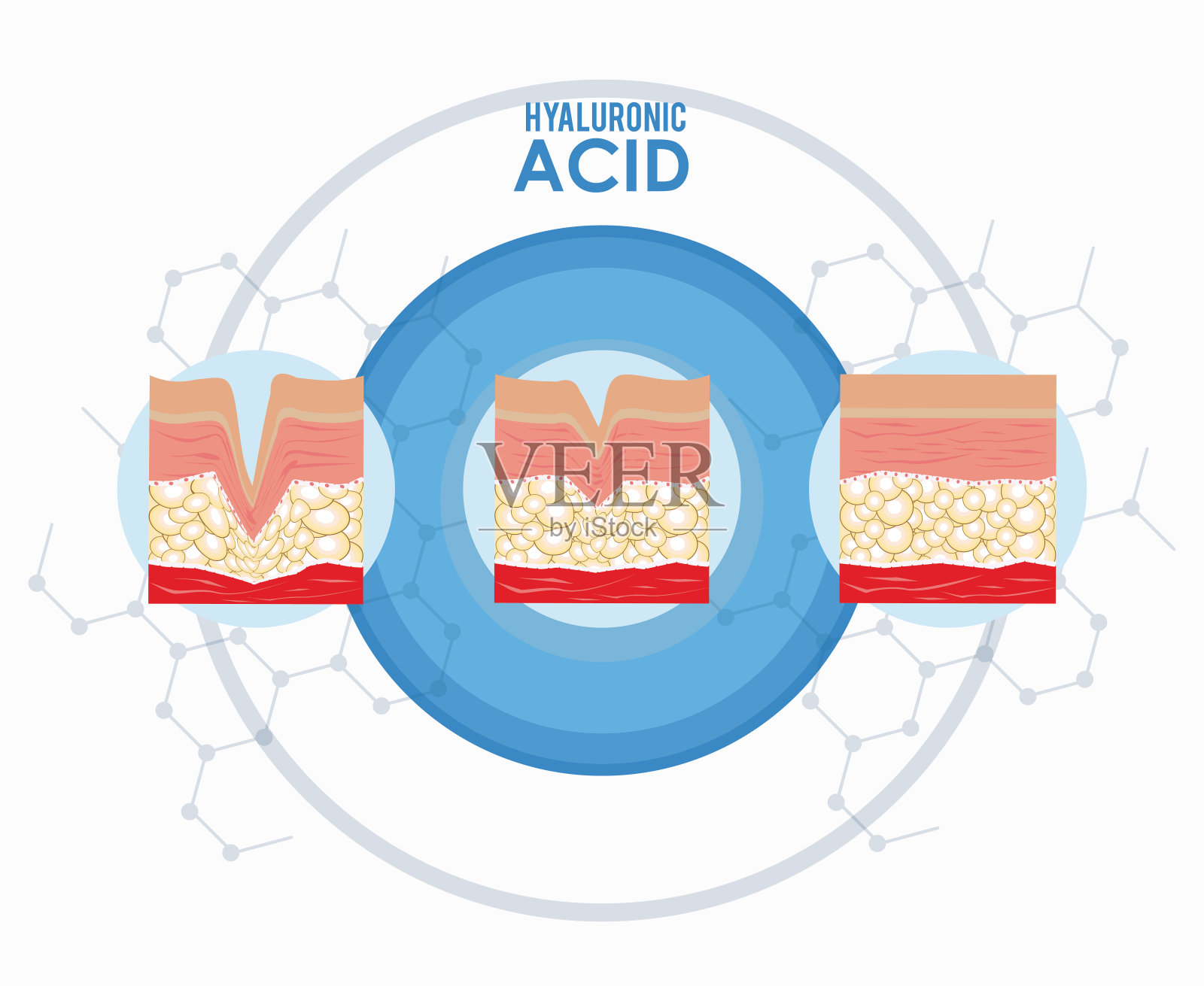 透明质酸注射液填充物信息图插画图片素材