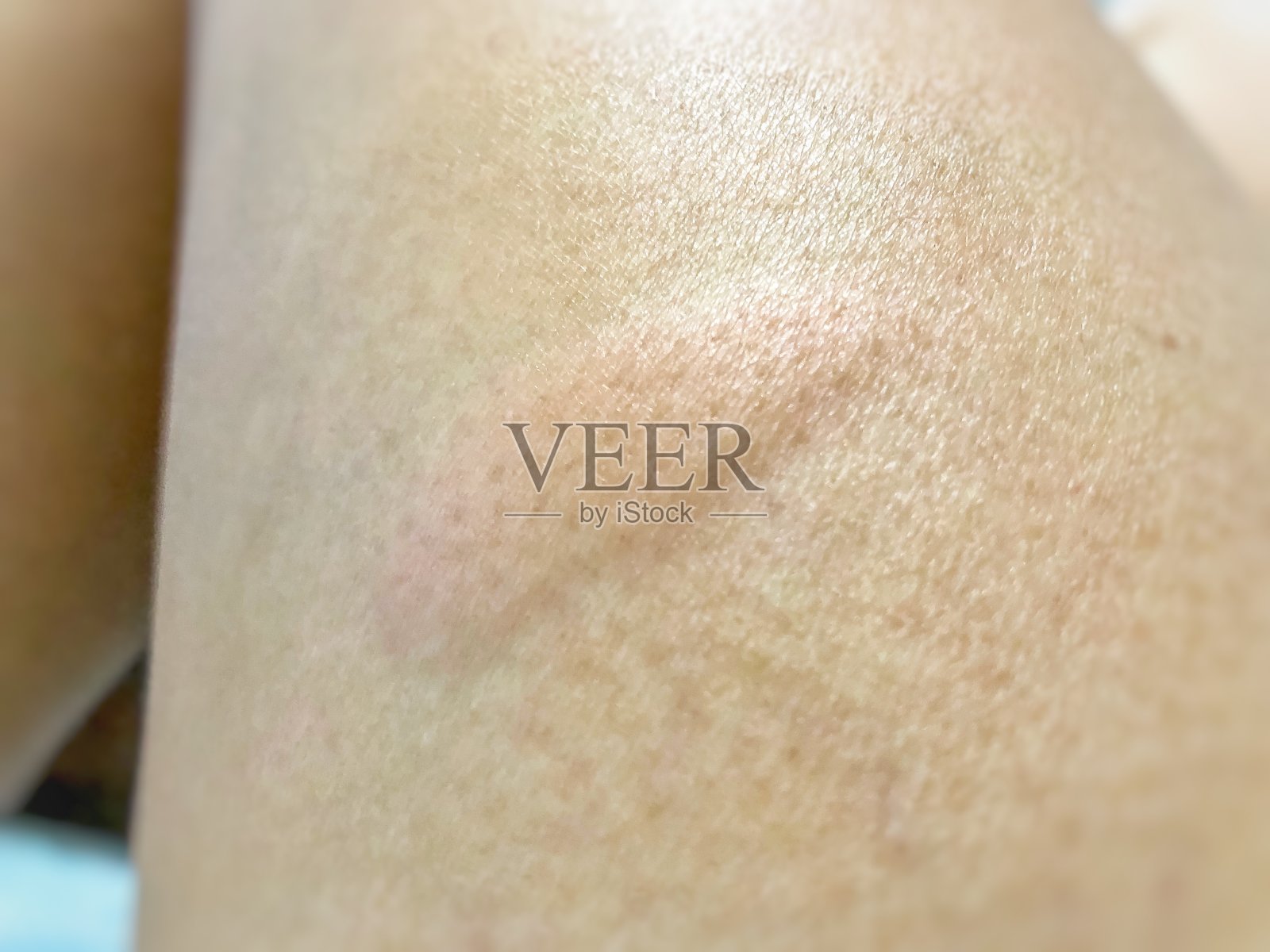 人类皮肤质地问题，荨麻疹照片摄影图片