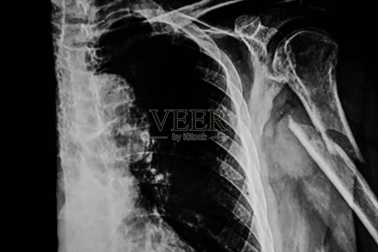 左肱骨骨折的Rx照片摄影图片