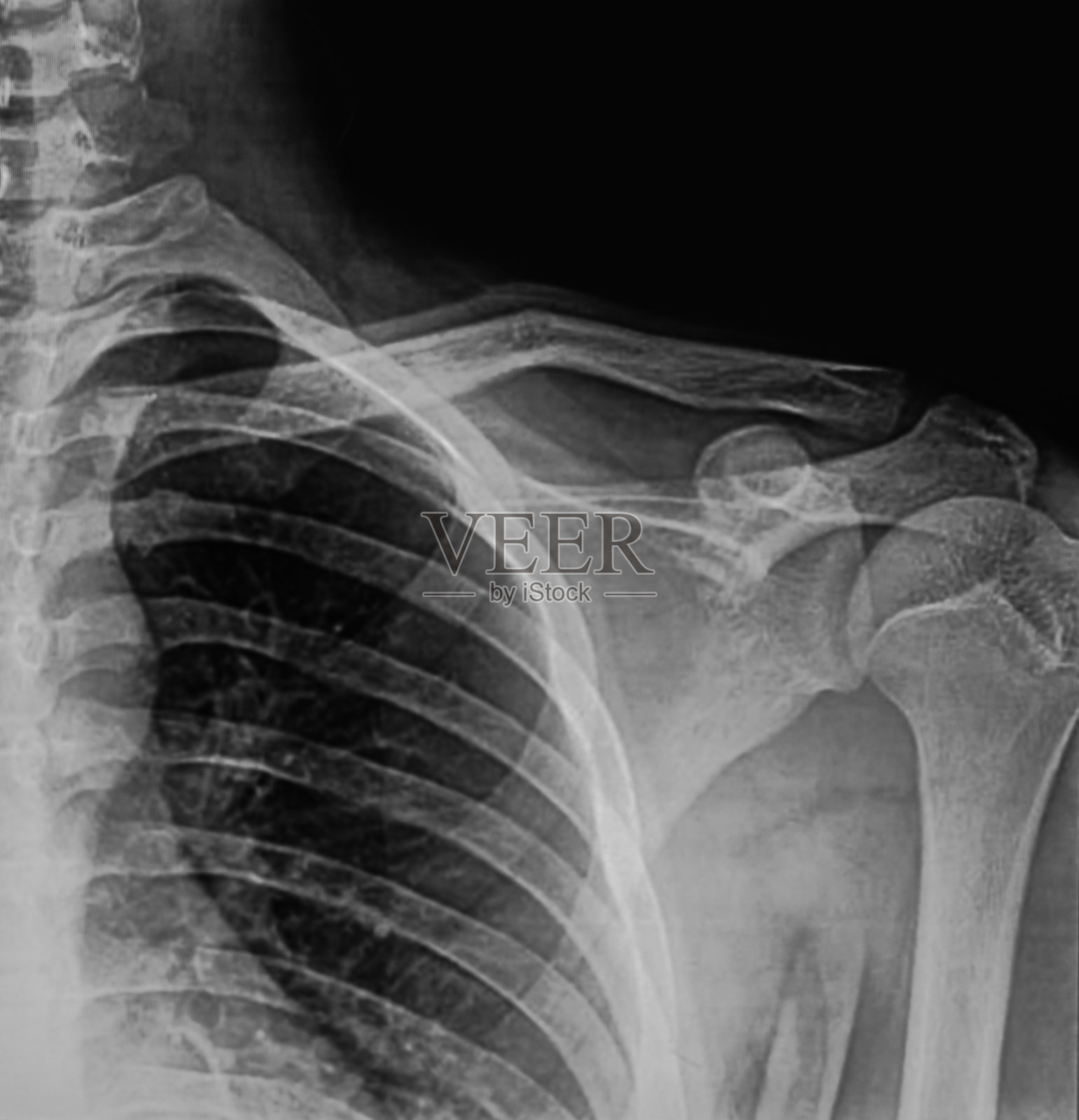 颈椎x光片，侧视图照片摄影图片