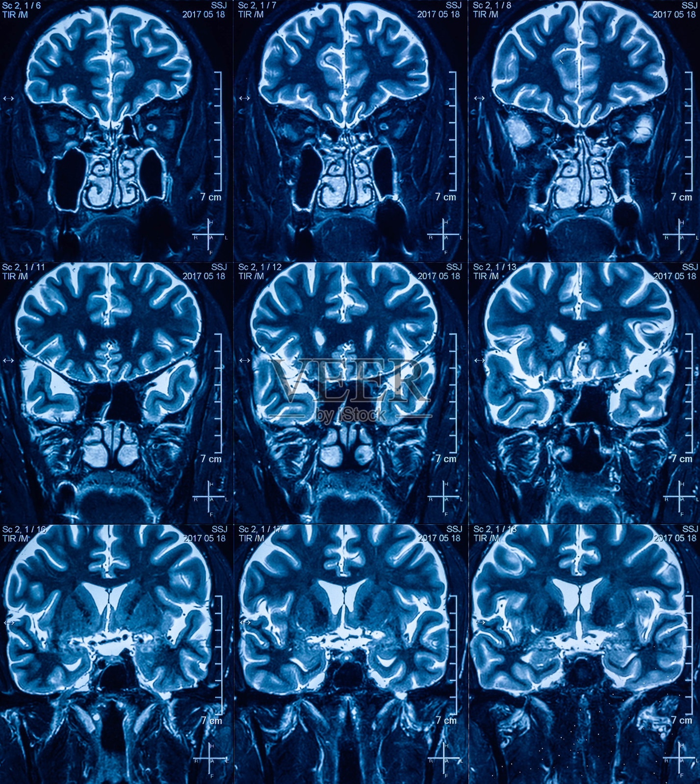 MRI扫描人类头部断层扫描照片摄影图片