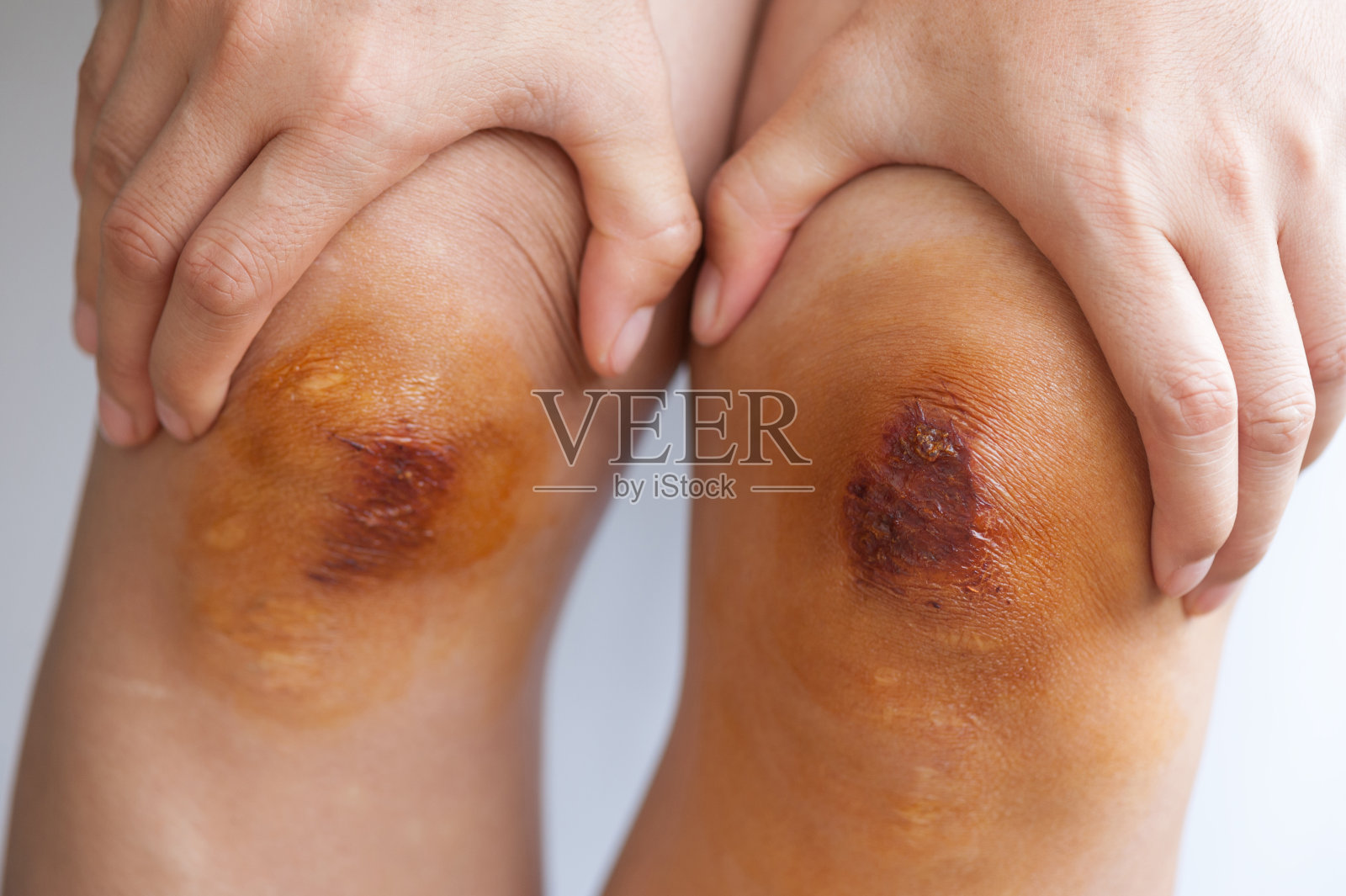 亚洲女性膝盖上有新伤口照片摄影图片