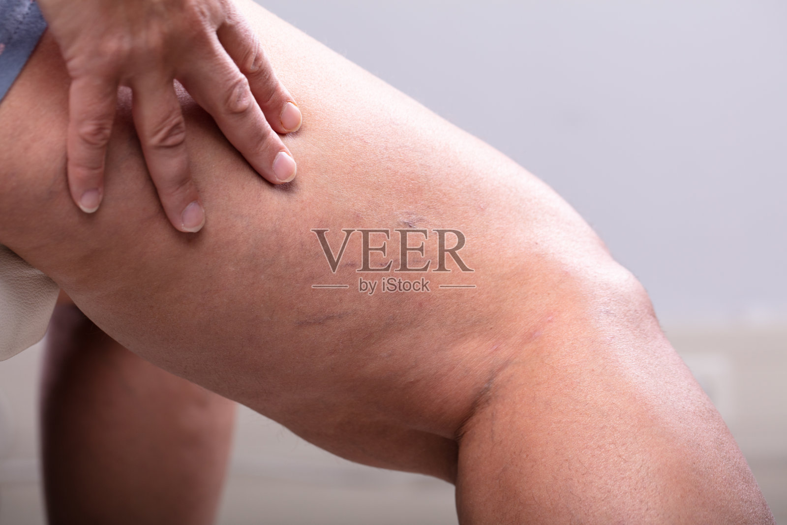 静脉曲张的前后治疗照片摄影图片