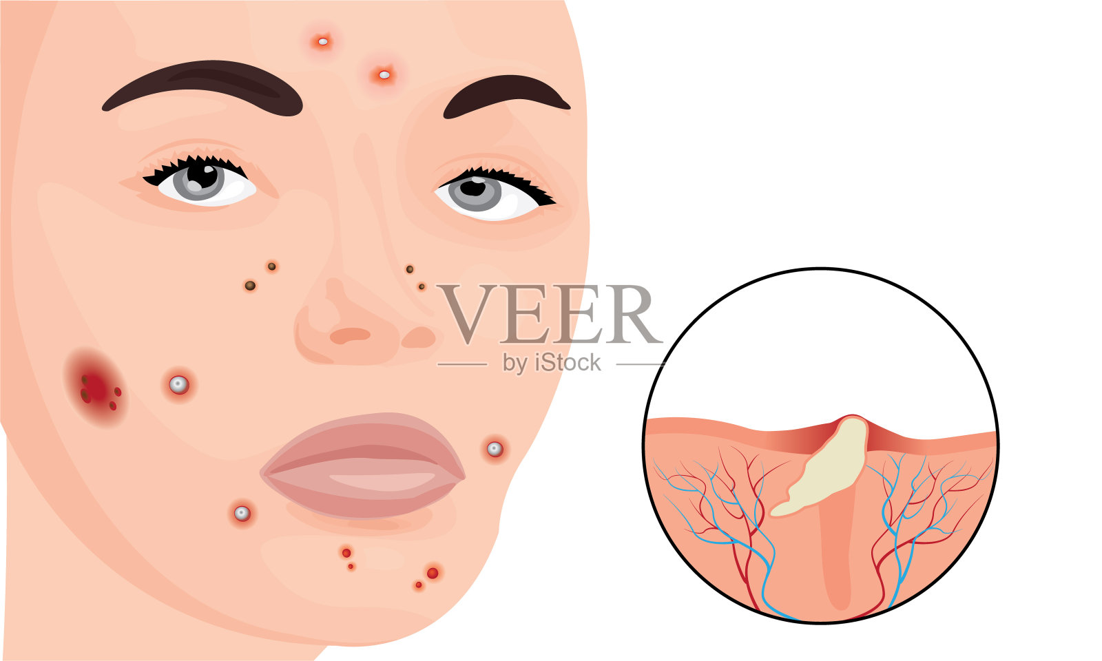 女人脸上的粉刺插画图片素材