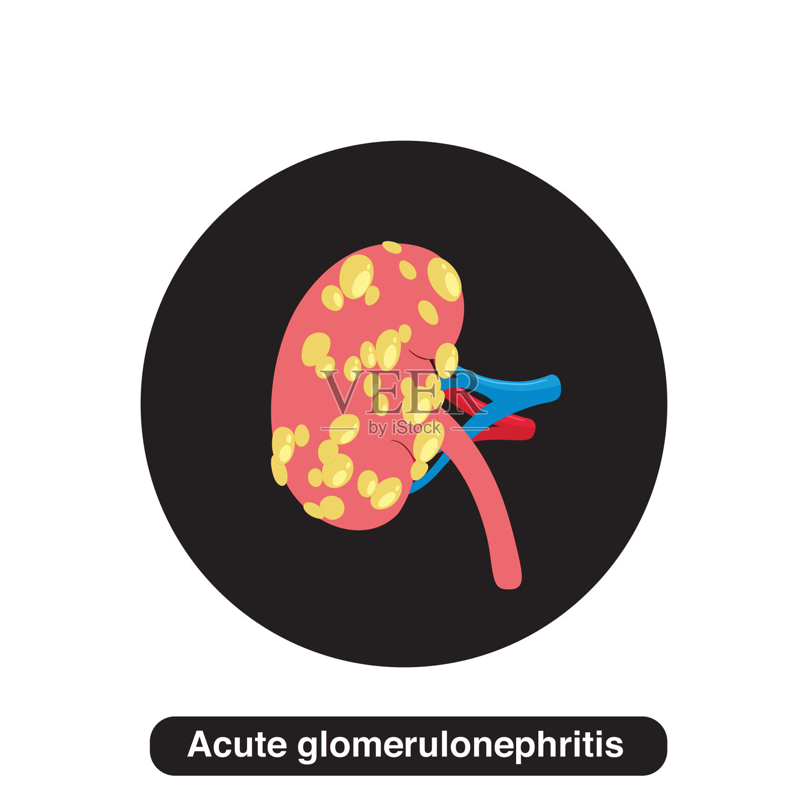 急性肾小球肾炎图解概念插画图片素材
