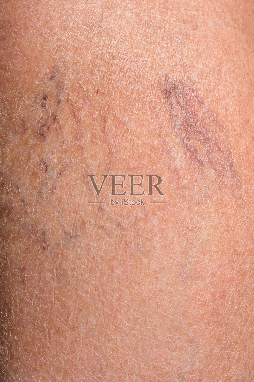 一个上了年纪的女人的腿的特写，这发展了一种疾病的静脉曲张照片摄影图片