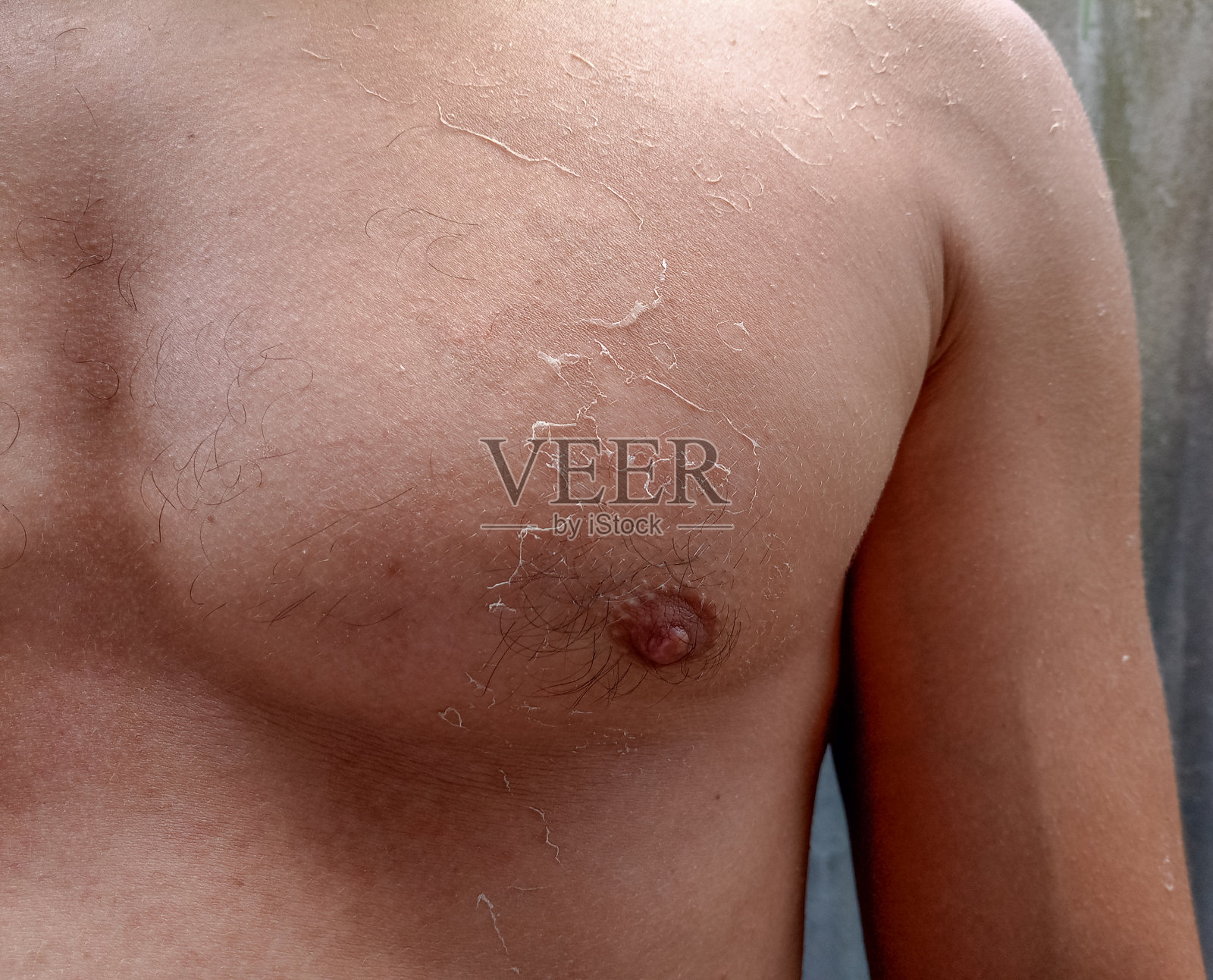 晒伤后皮肤的脱皮照片摄影图片