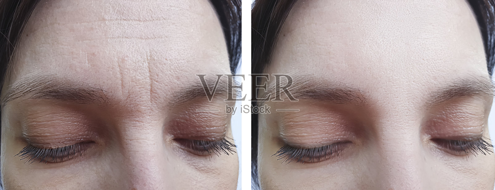 女性前额皱纹治疗前照片摄影图片