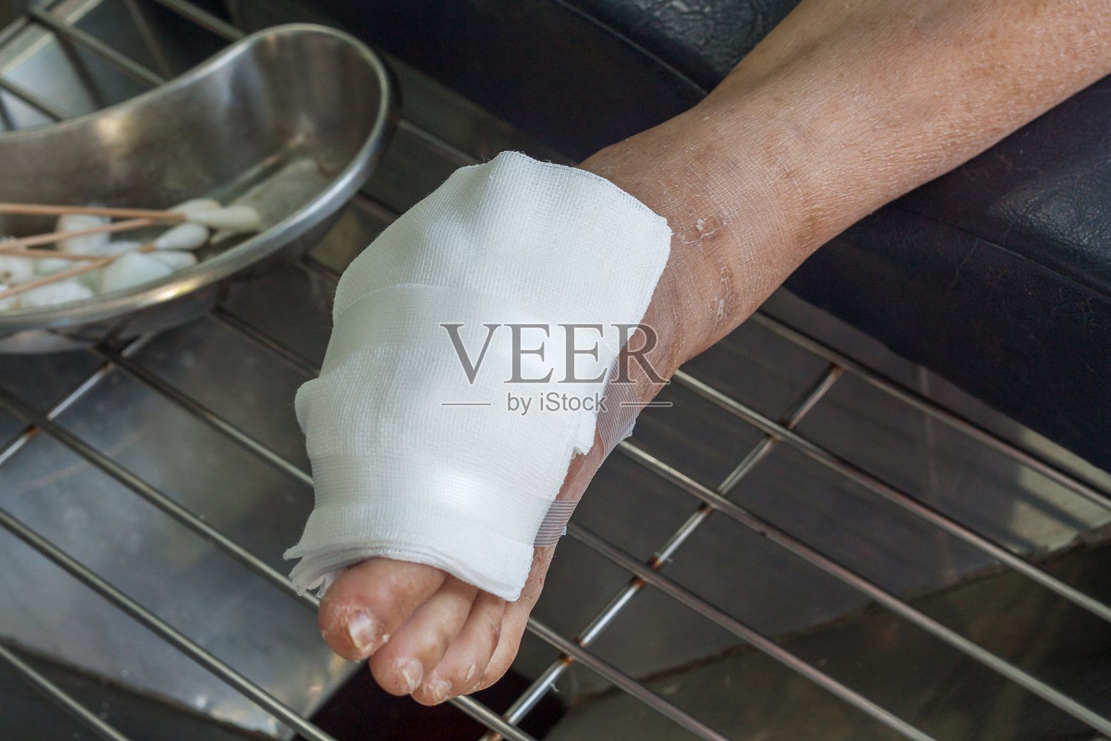 糖尿病伤口照片摄影图片