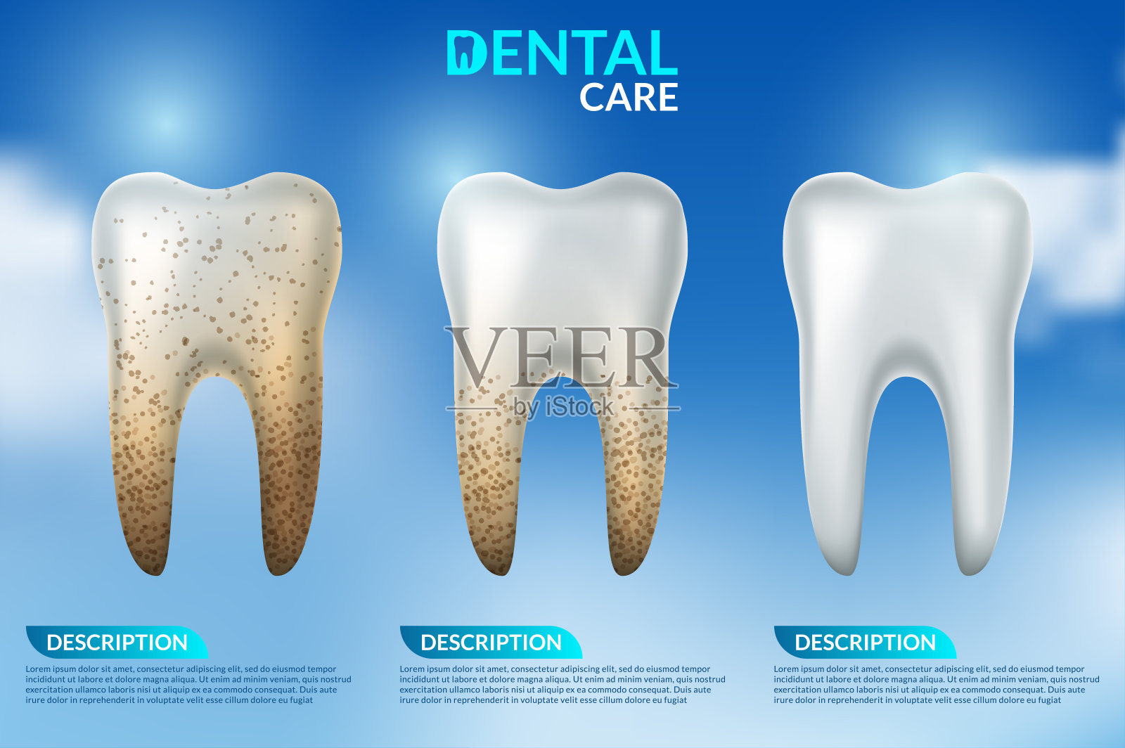 牙齿美白3d概念。清洁牙齿和脏牙美白前后对比插画图片素材
