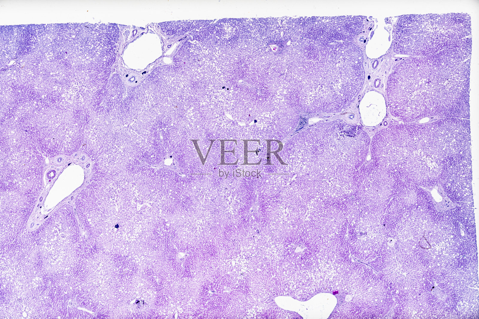 肝脂肪变性镜下可见圆形脂肪沉积照片摄影图片