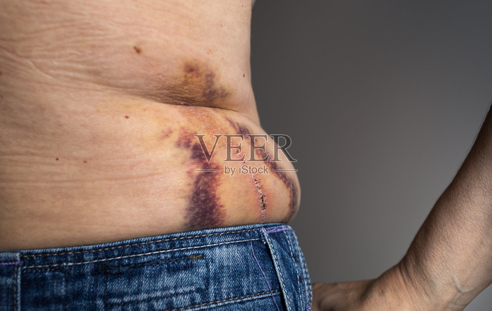 大的痛苦的血肿照片摄影图片