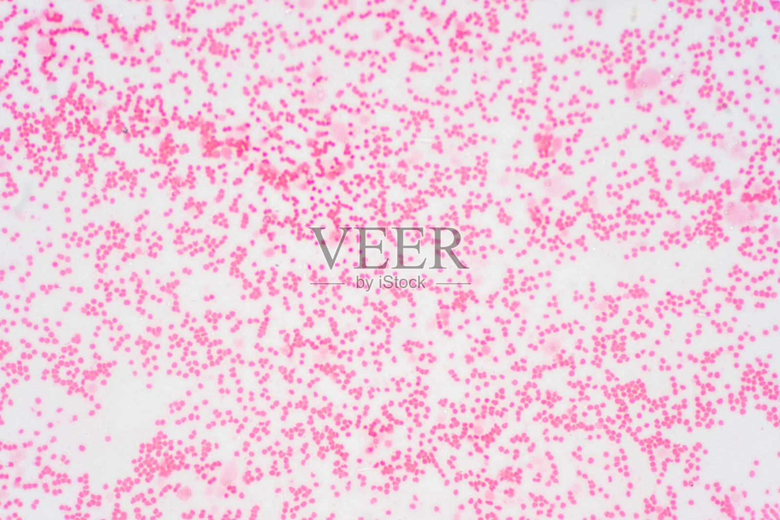 显微镜下骨髓增生异常的骨髓活检。骨髓活检的组织学组织。照片摄影图片