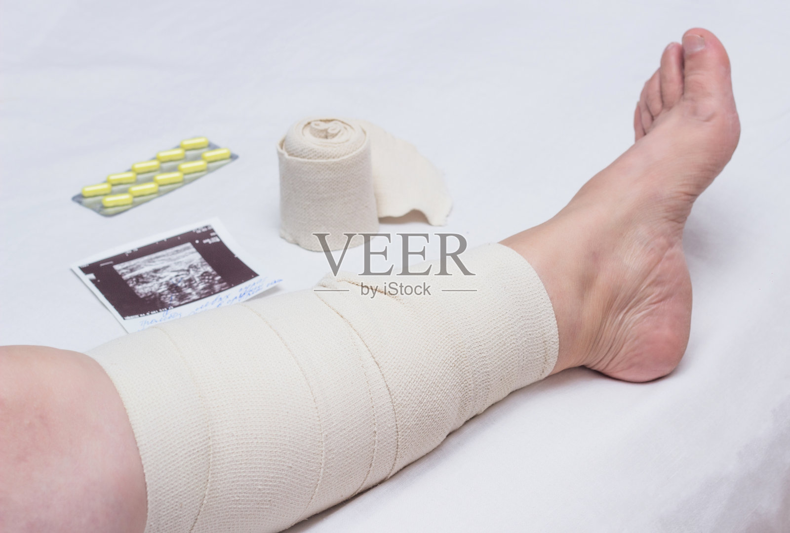 压迫治疗女性腿部静脉曲张，治疗静脉曲张用弹性绷带，血管照片摄影图片