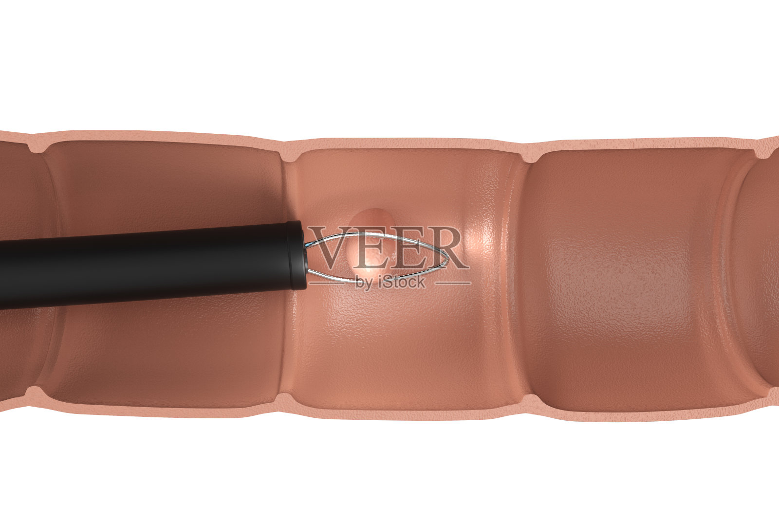 内镜切除结肠息肉照片摄影图片