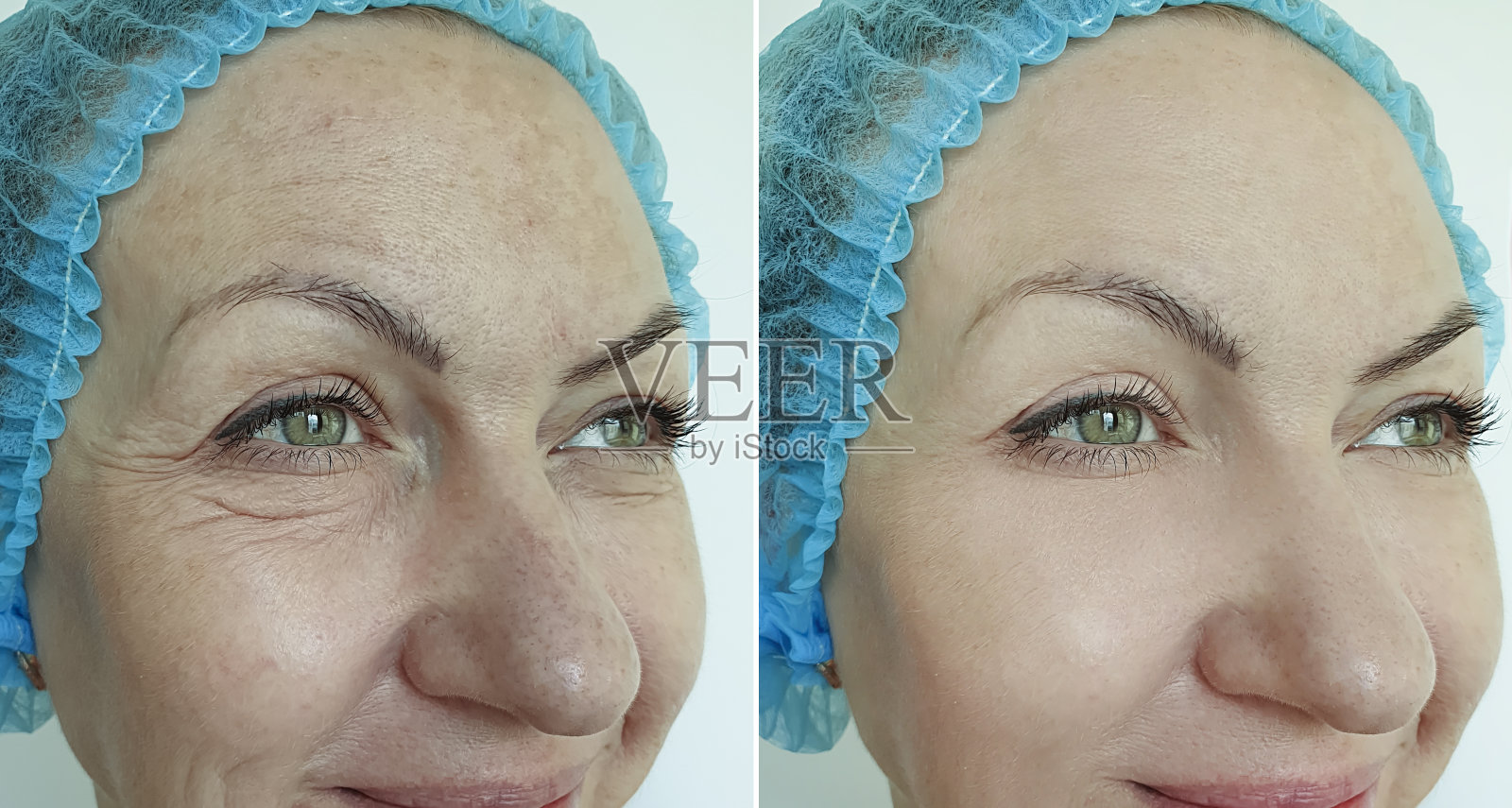 女人的眼睛皱纹治疗前后照片摄影图片