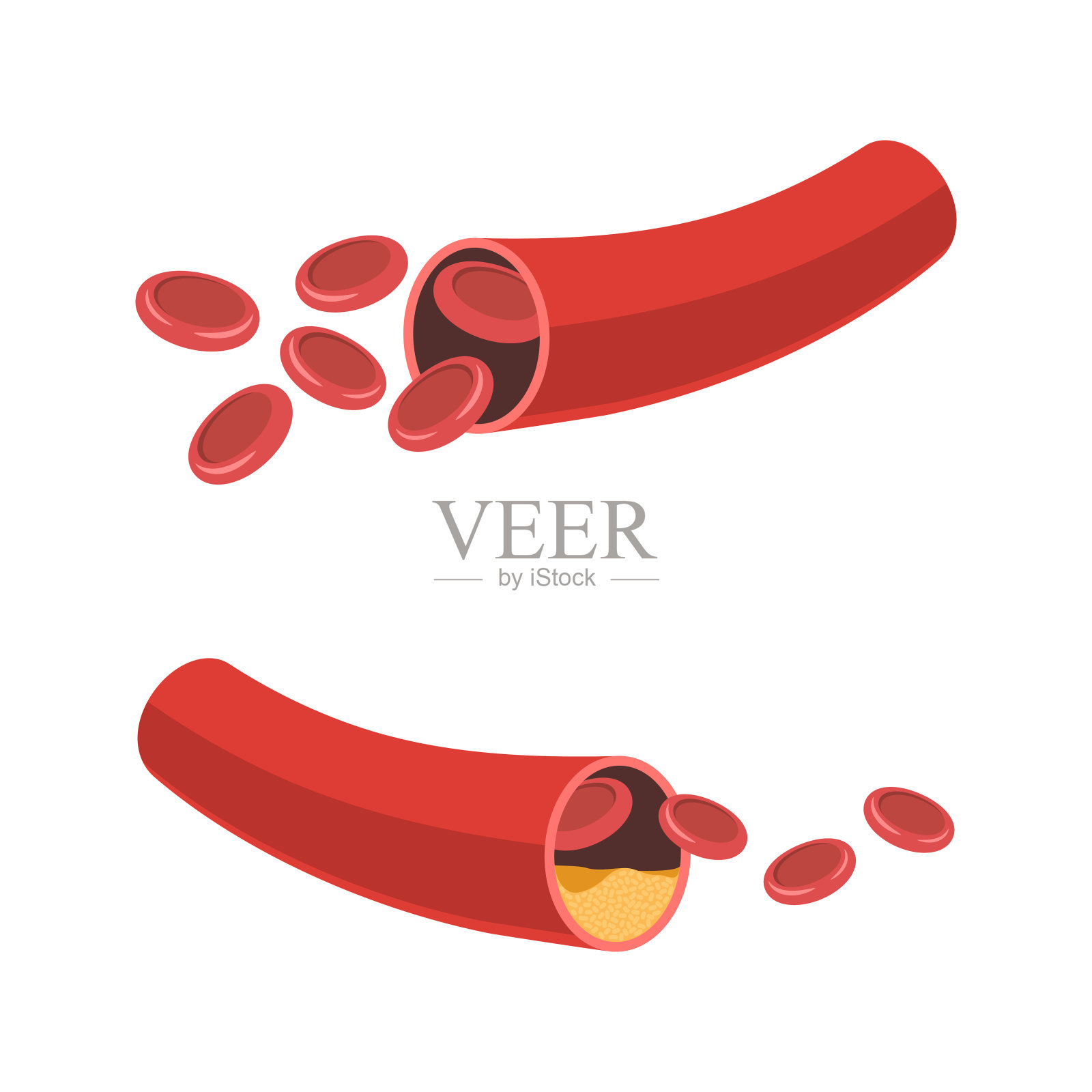 正常动脉和变窄插画图片素材