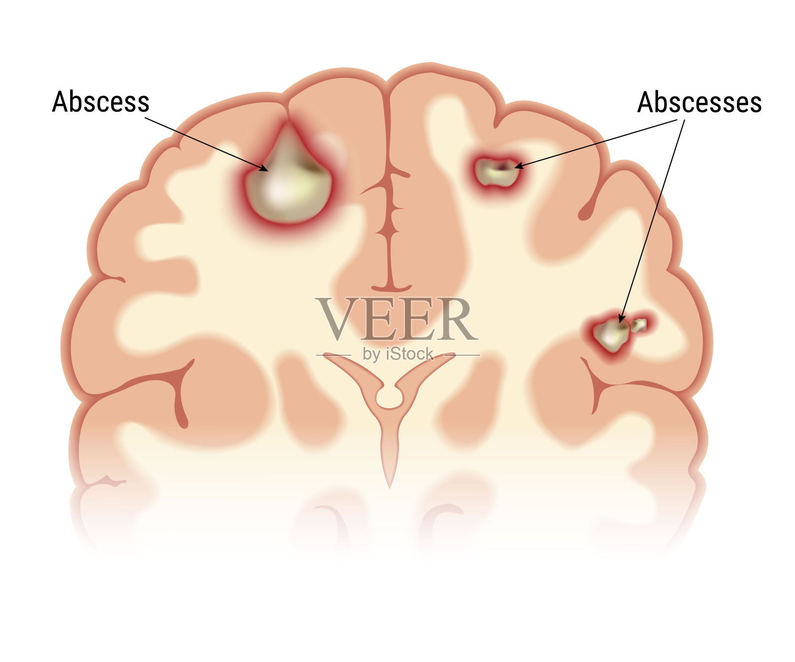 颅内脓肿向量设计元素图片