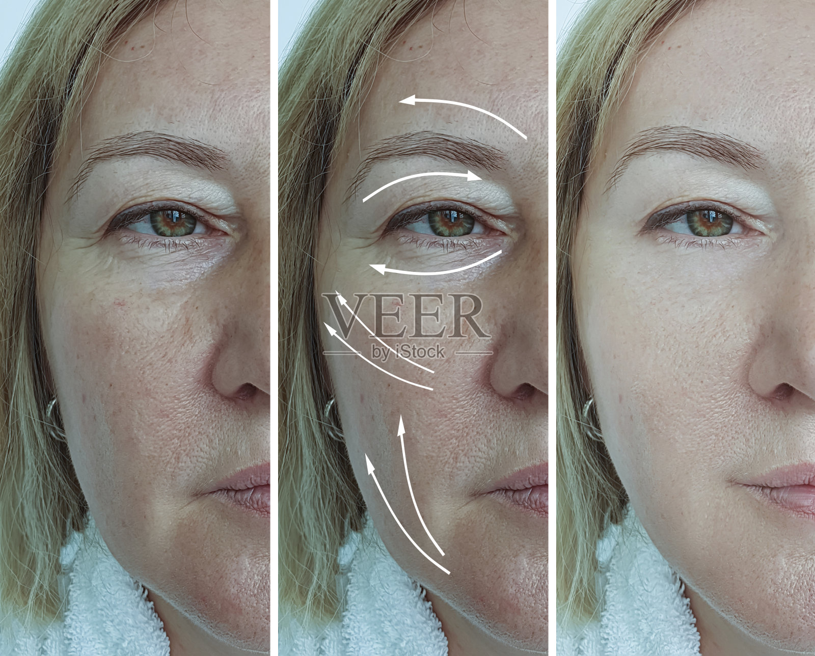 老年妇女皱纹治疗前后照片摄影图片