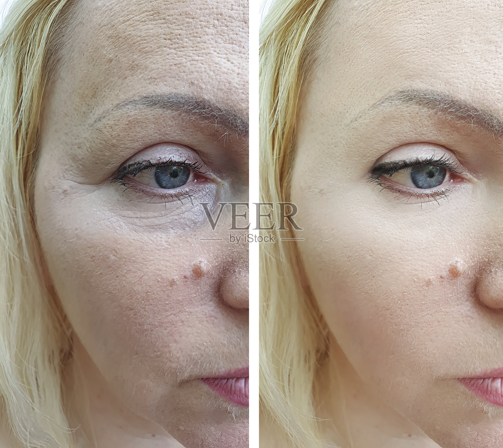 女性面部皱纹治疗前后照片摄影图片