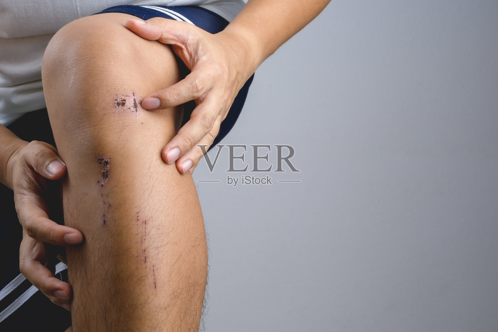 摔伤或自行车事故造成的擦伤、膝伤、结痂、小腿皮肤少许照片摄影图片