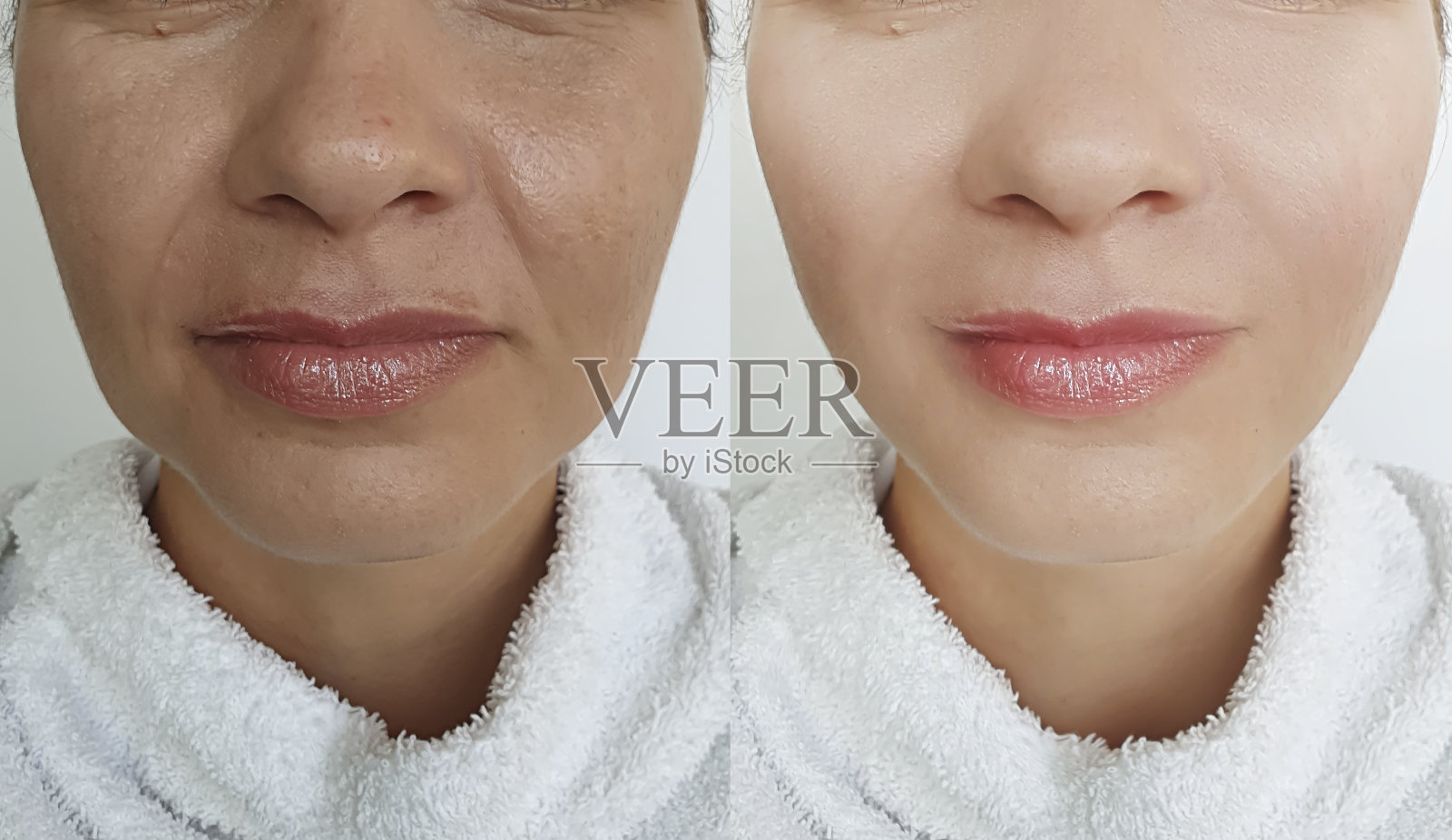 女性面部皱纹治疗前后照片摄影图片