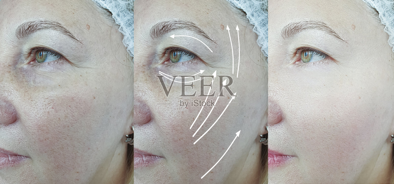 老年妇女脸部皱纹治疗前后箭头照片摄影图片