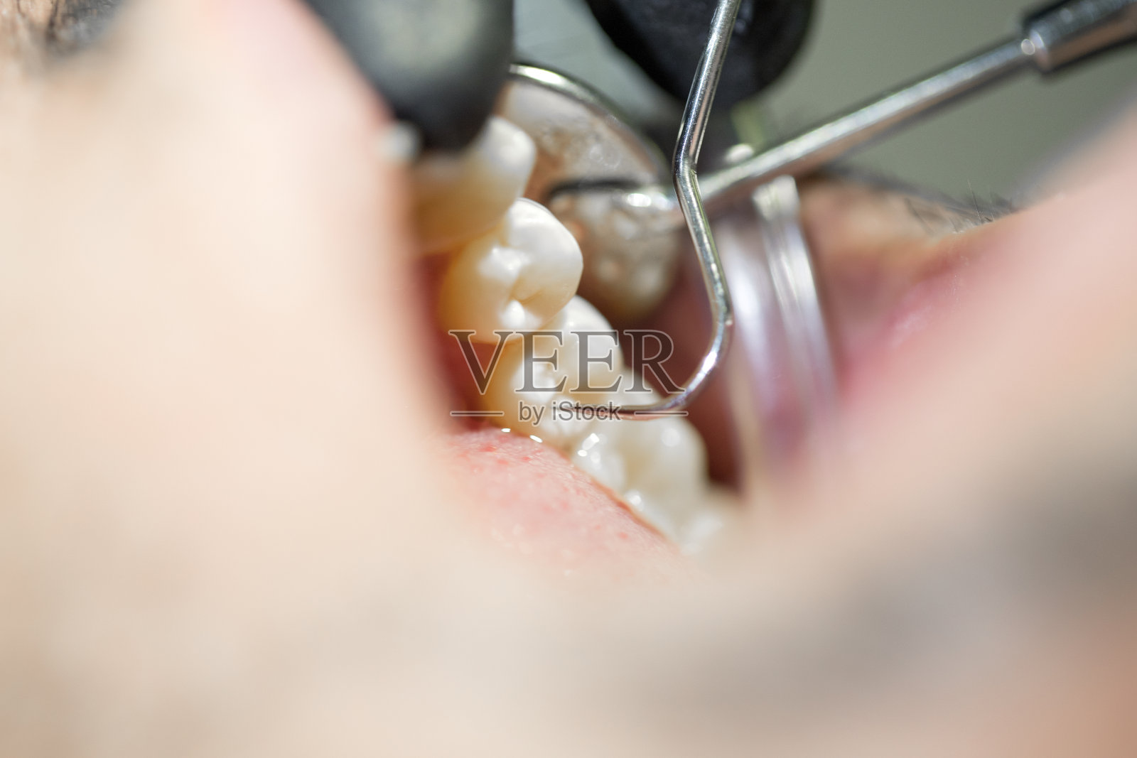 牙医清洁牙齿照片摄影图片