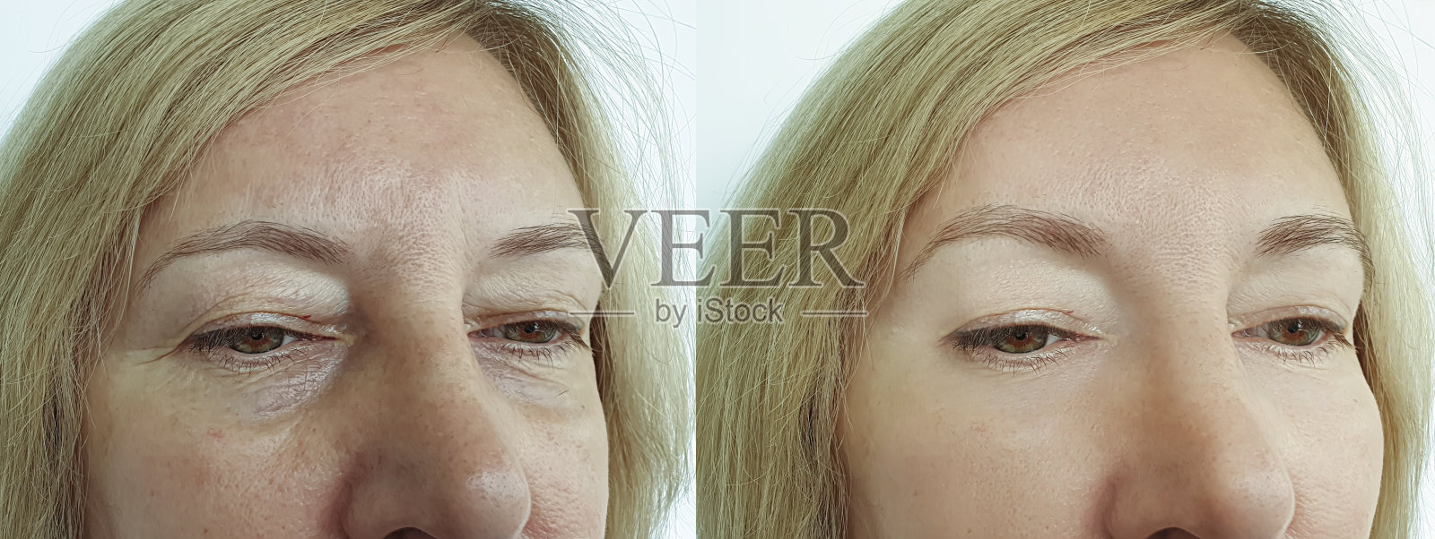 治疗前后女性面部皱纹对比拼贴照片摄影图片