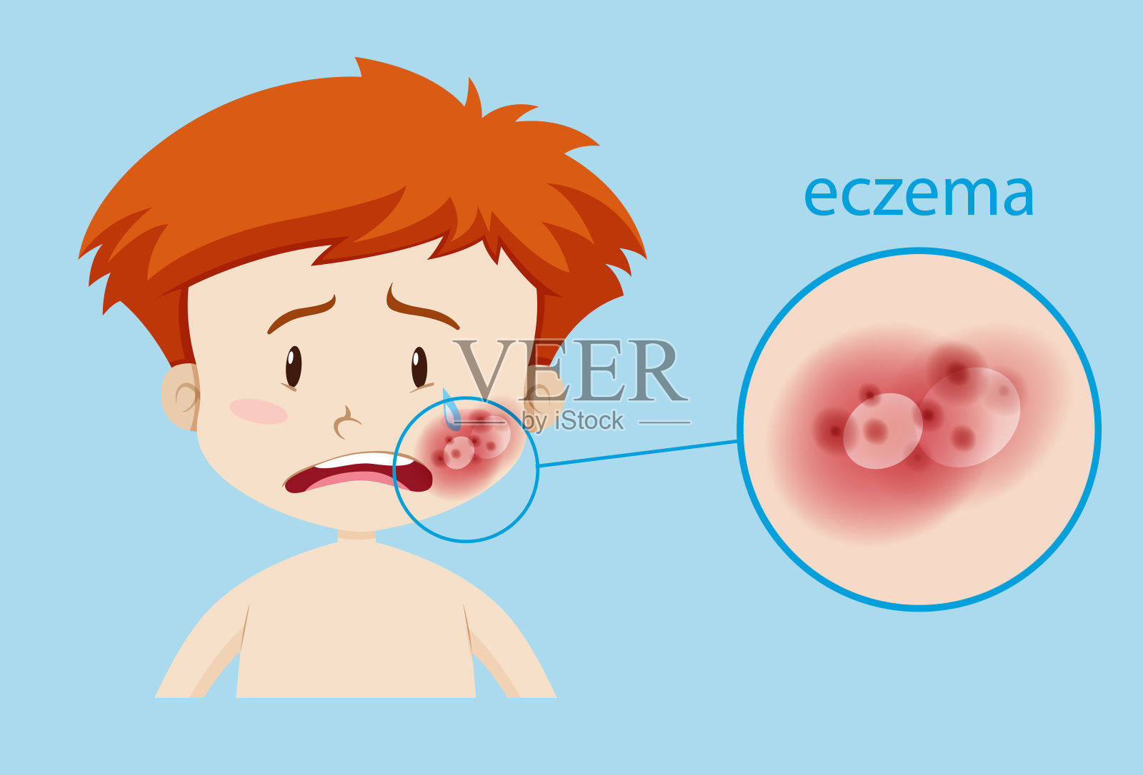 湿疹患儿插画图片素材