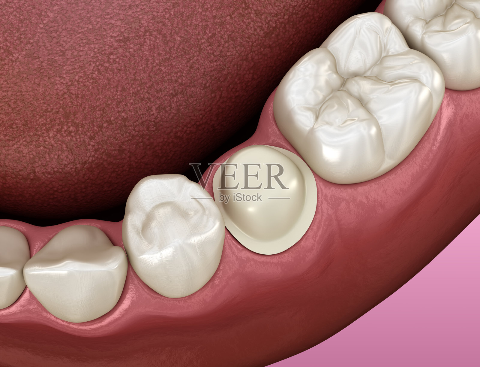 准备好前磨牙，准备金属烤瓷冠放置。医用精准3D插图照片摄影图片